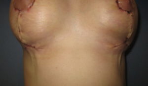 Mondor S Bands After Plastic Surgery Of The Breast